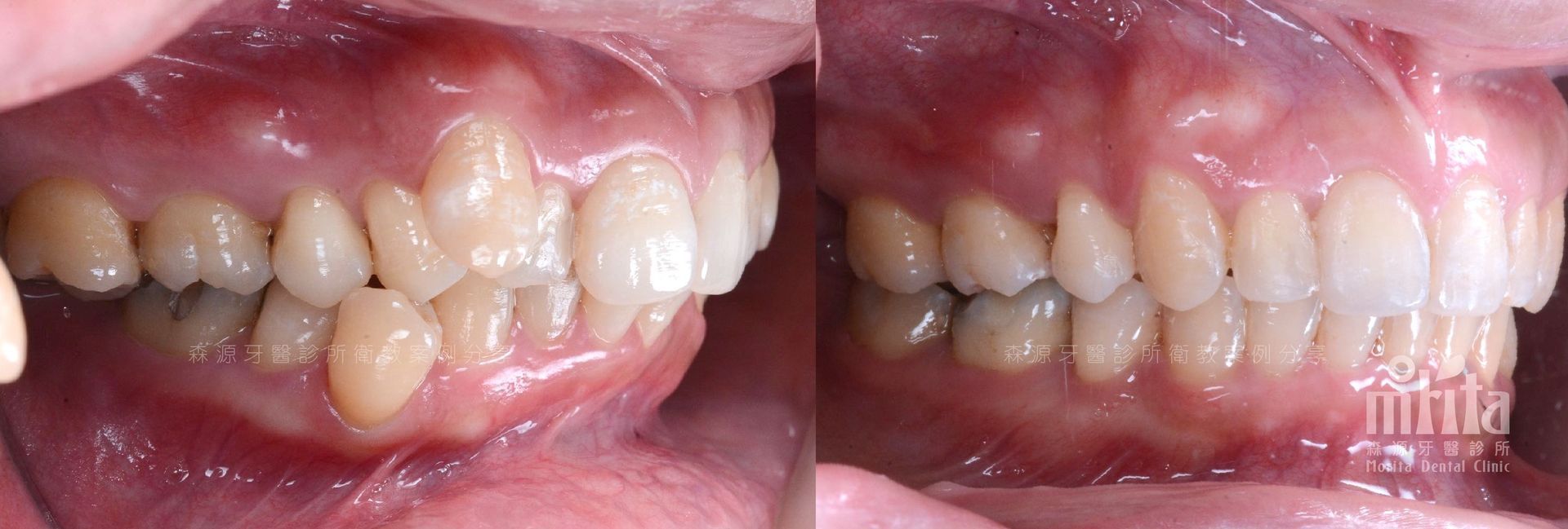 A before and after picture of a person 's teeth.