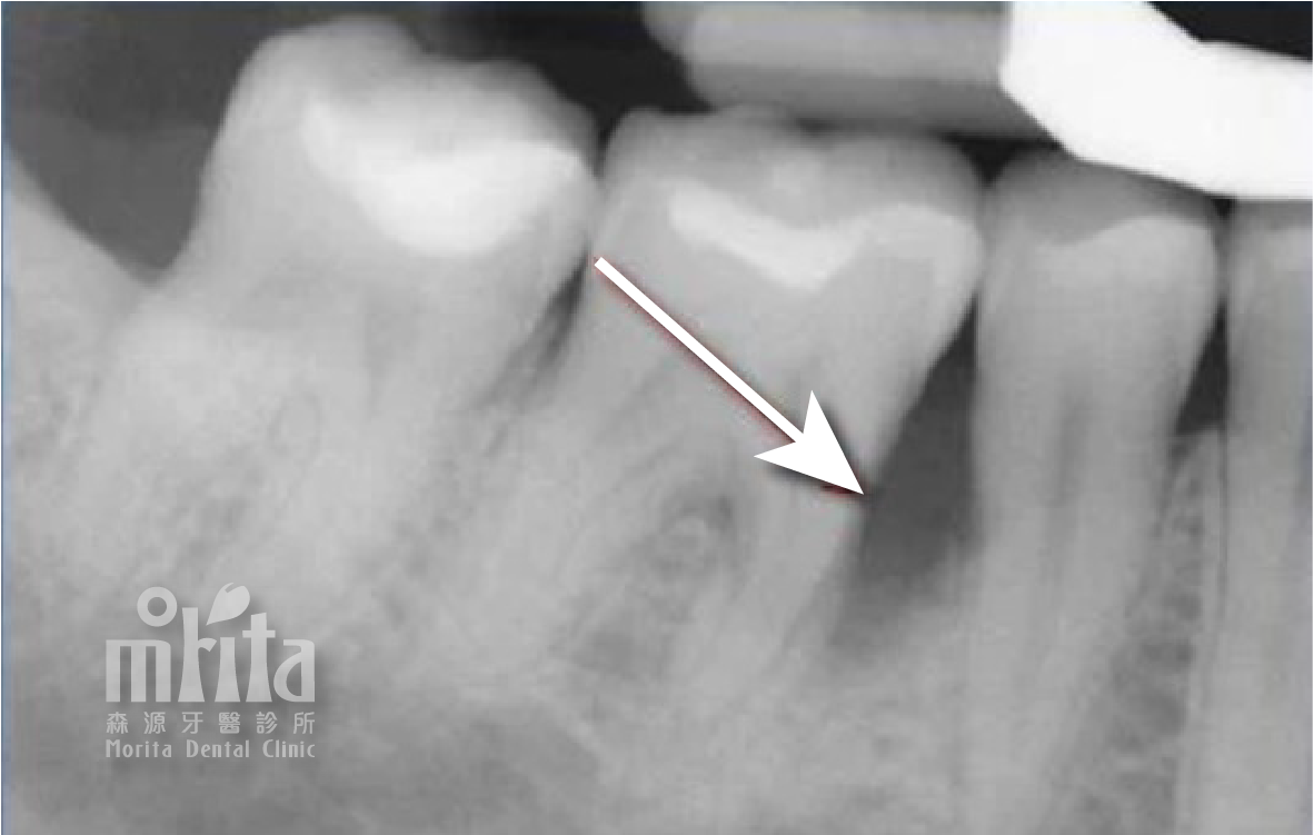 An x-ray of a tooth with an arrow pointing to it