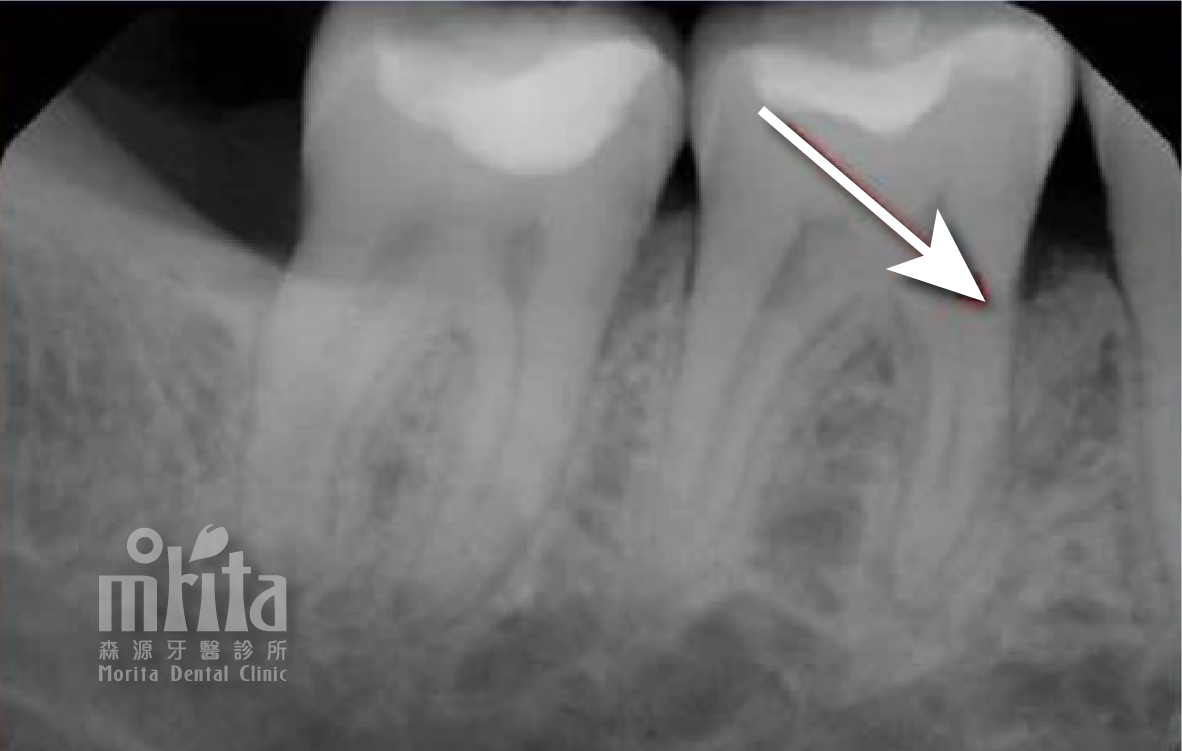An x-ray of a tooth with an arrow pointing to it