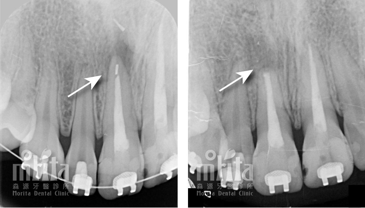 A black and white x-ray of a person 's teeth before and after dental treatment.