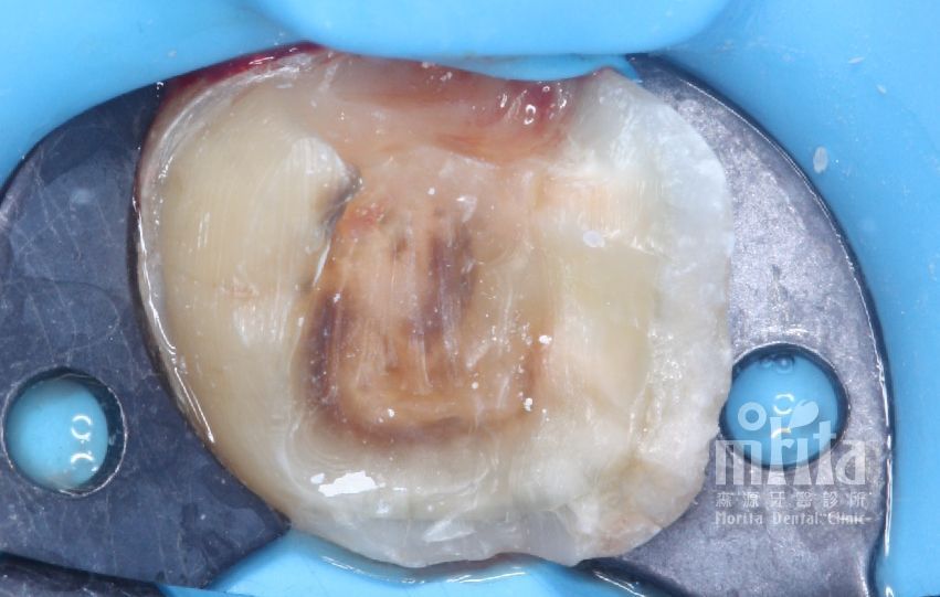 A close up of a tooth with a hole in it.