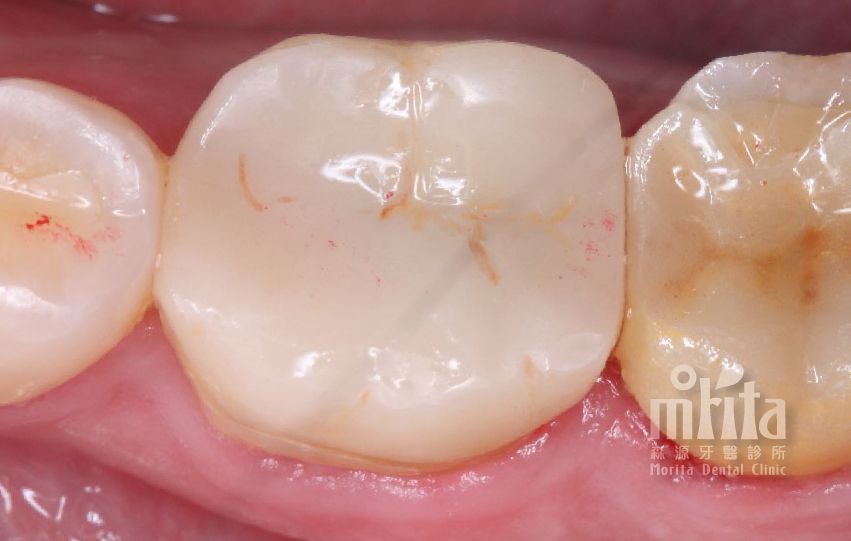 A close up of a person 's teeth with a white filling.