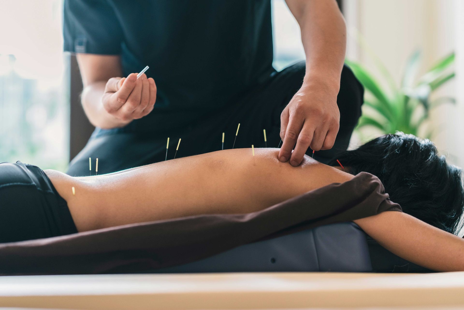 Person receiving acupuncture treatment on a massage table, with thin needles inserted along the back.