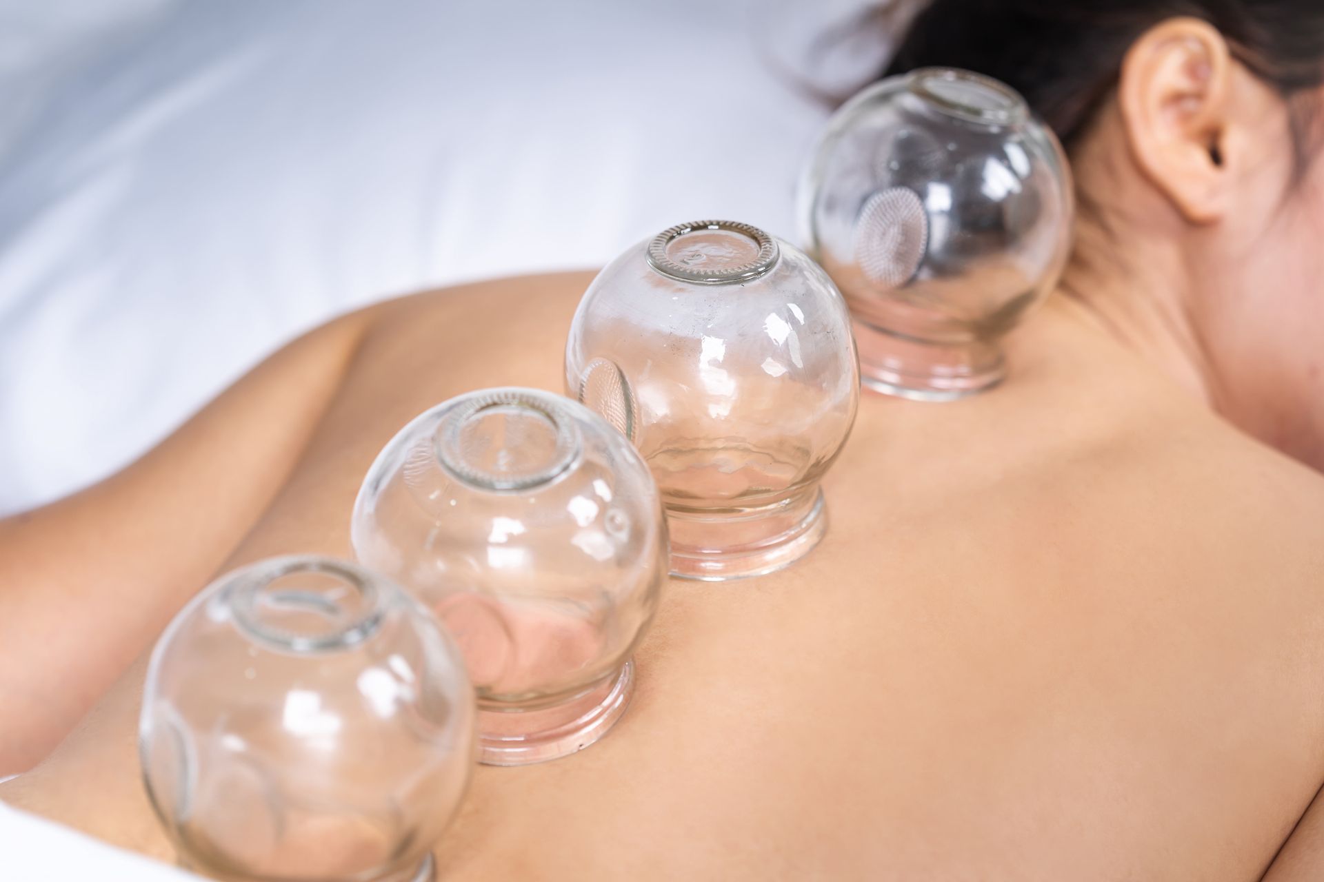 Glass cups used for cupping therapy on a person’s back