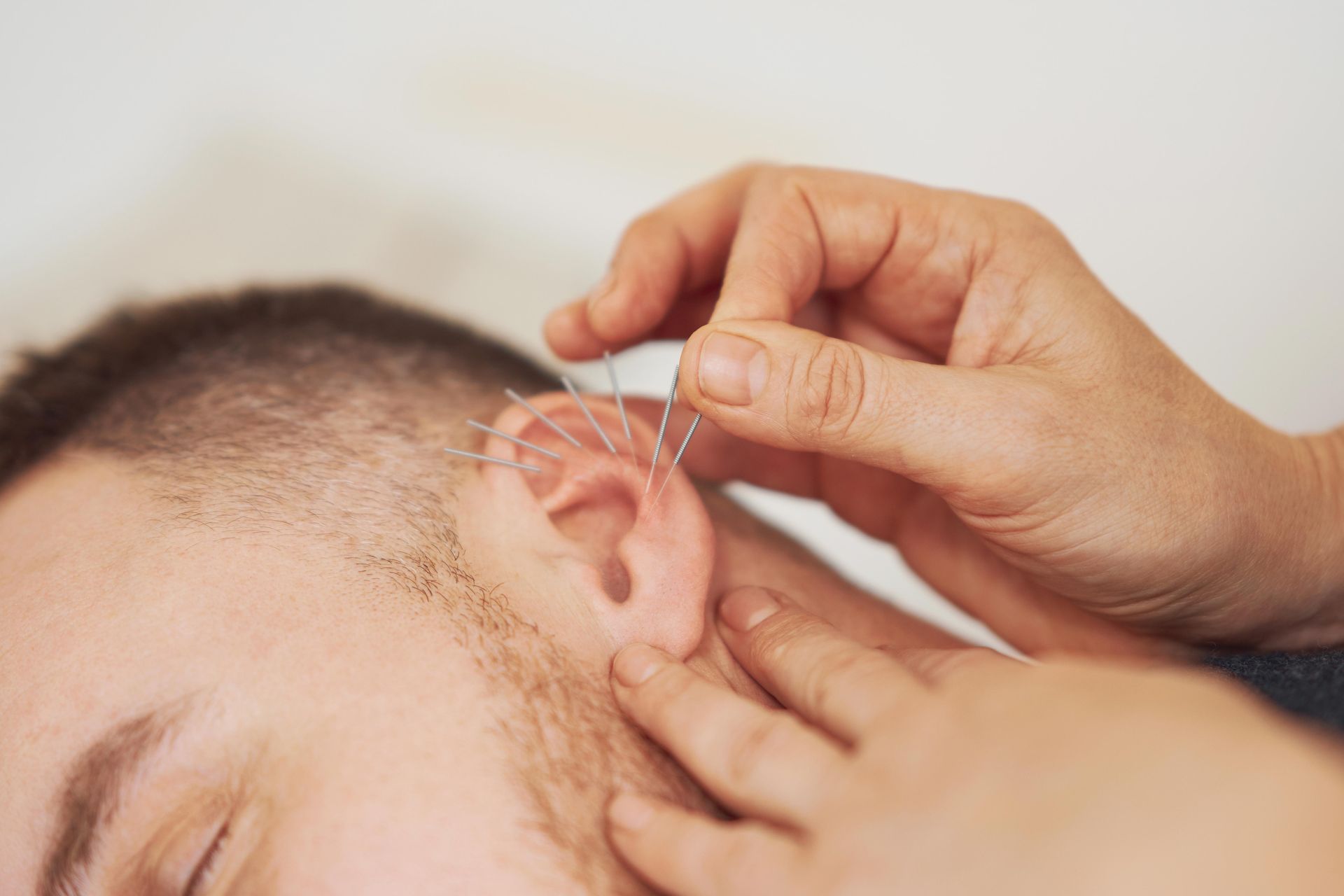 Hand placing acupuncture needles in the ear of a reclining person