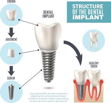 Dental implant - Periodontist in Vineland, NJ