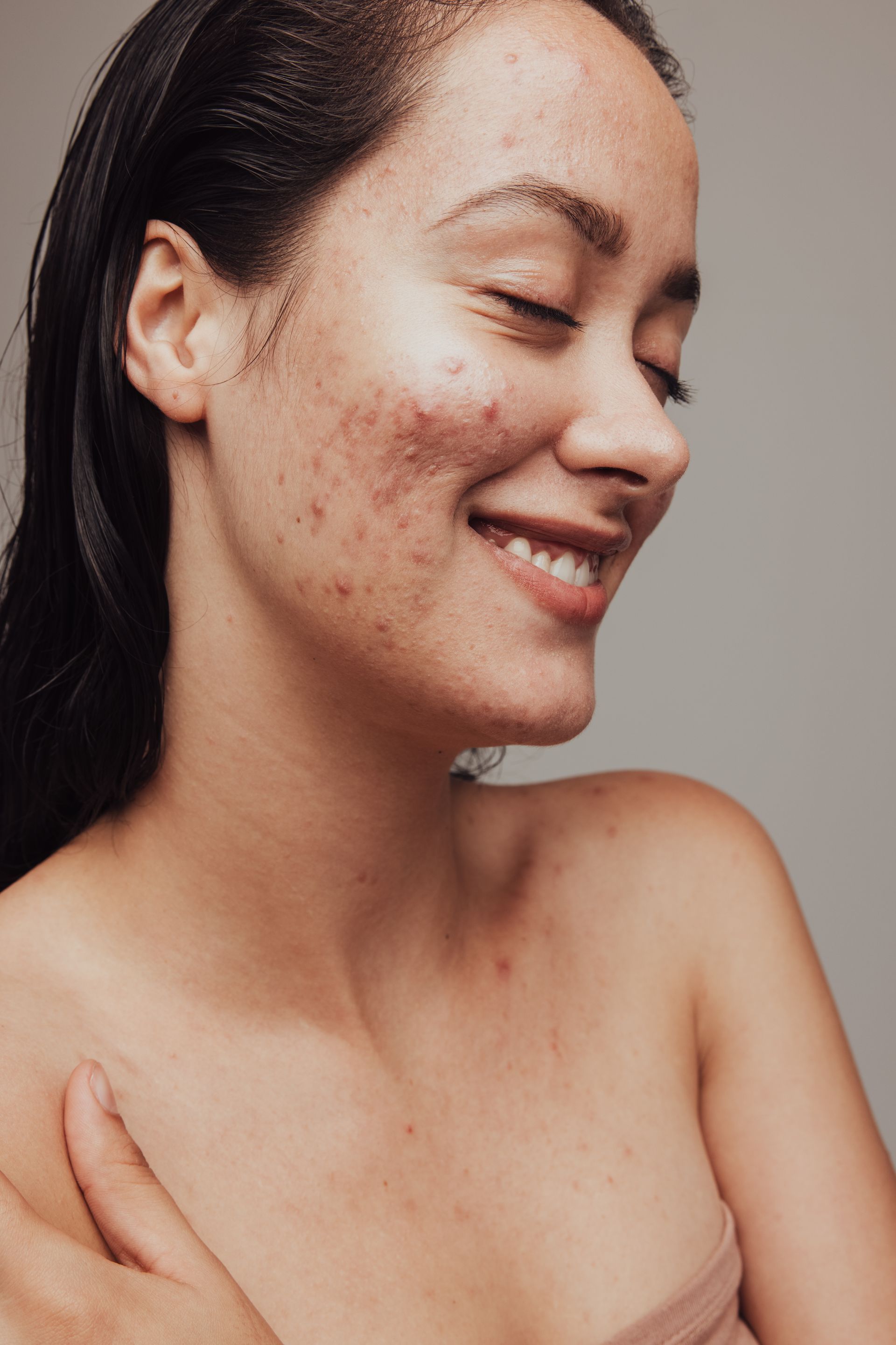 A woman with acne on her face is smiling.