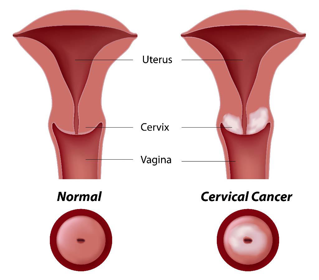 image of Cervical cancer