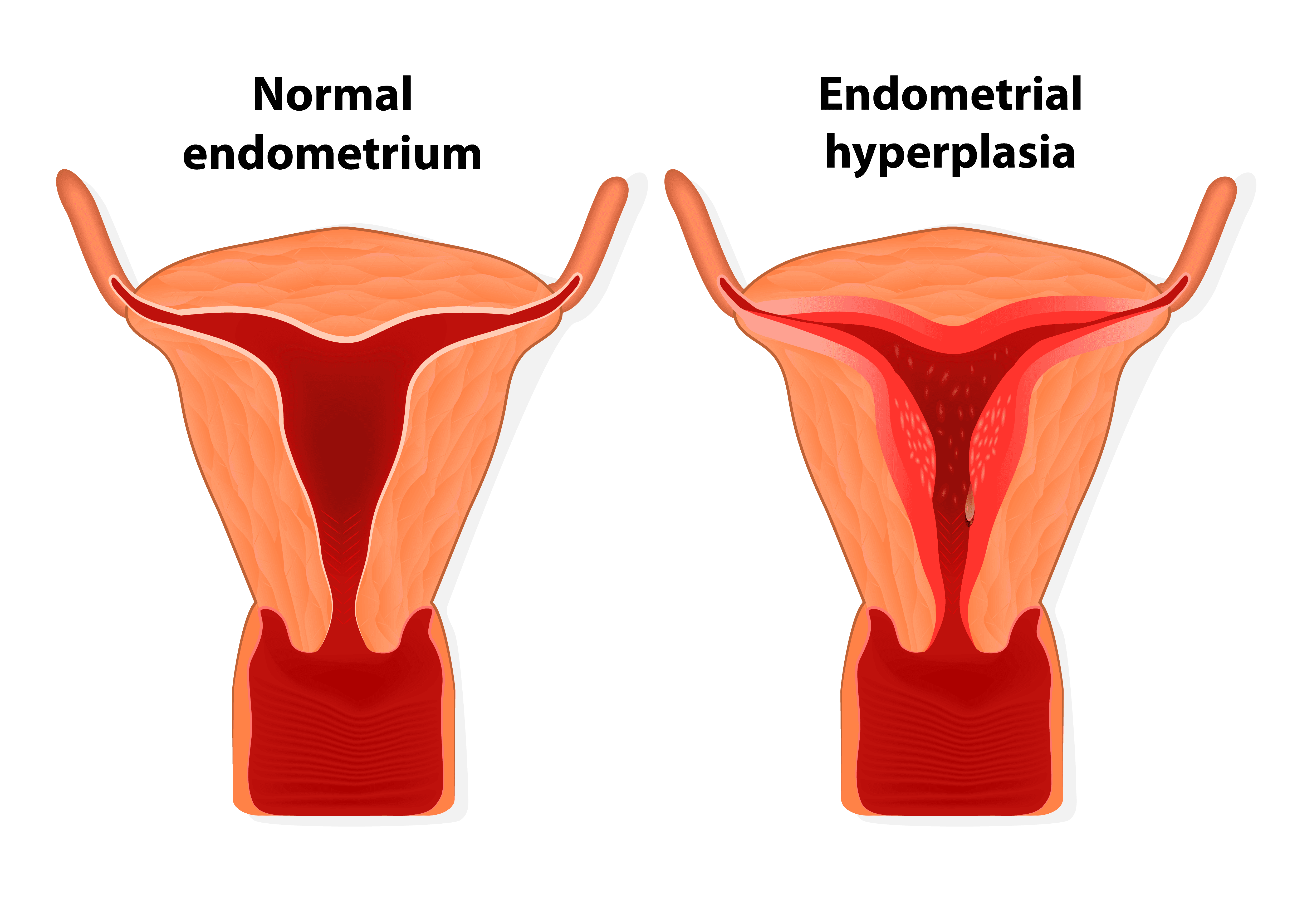 Image of Endometrial hyperplasia is an overgrowth of tissue in the endometrium uterus. The uterine lining becomes too thick which results in abnormal bleeding.