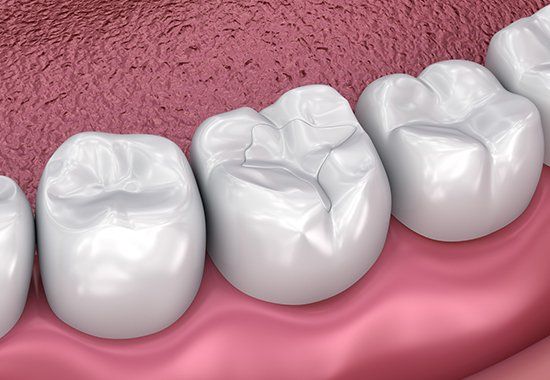Teeth with Sealant — Colorado Springs, CO — Smile Heart Dental Hygiene