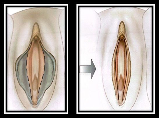 Labioplastia