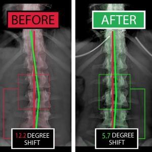 A before and after picture of a person 's spine