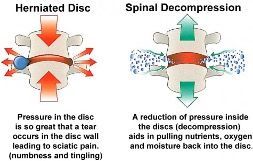 Diagram: Herniated disc (pressure) vs. spinal decompression (reduction) of spinal discs, with red and green arrows.