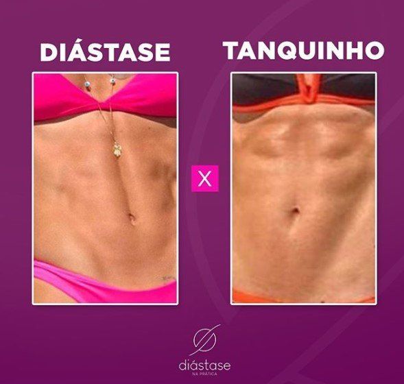 Diastase Nao Acontece So Na Maternidade