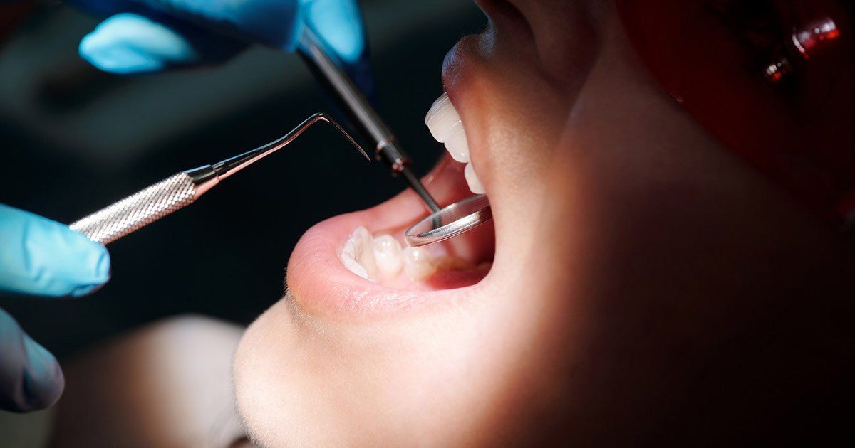 dental fillings, dental restoration, dentist in bayside ny, bayside ny dentist