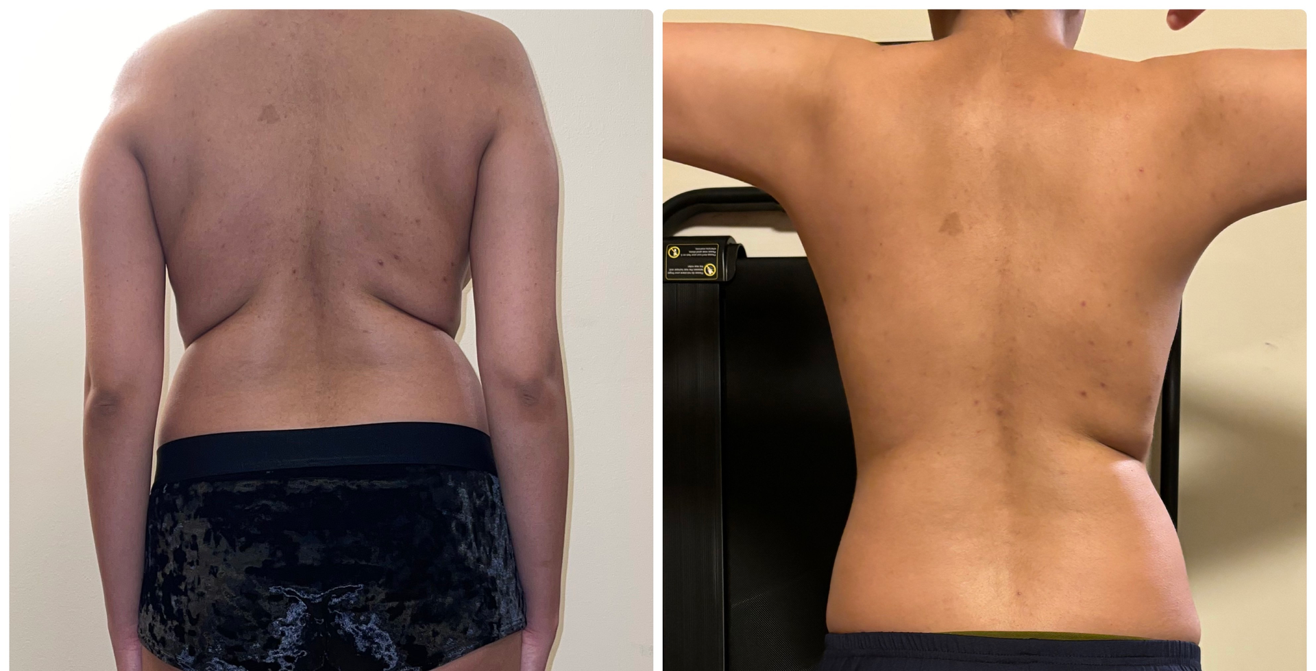 A before and after picture of a person 's back.