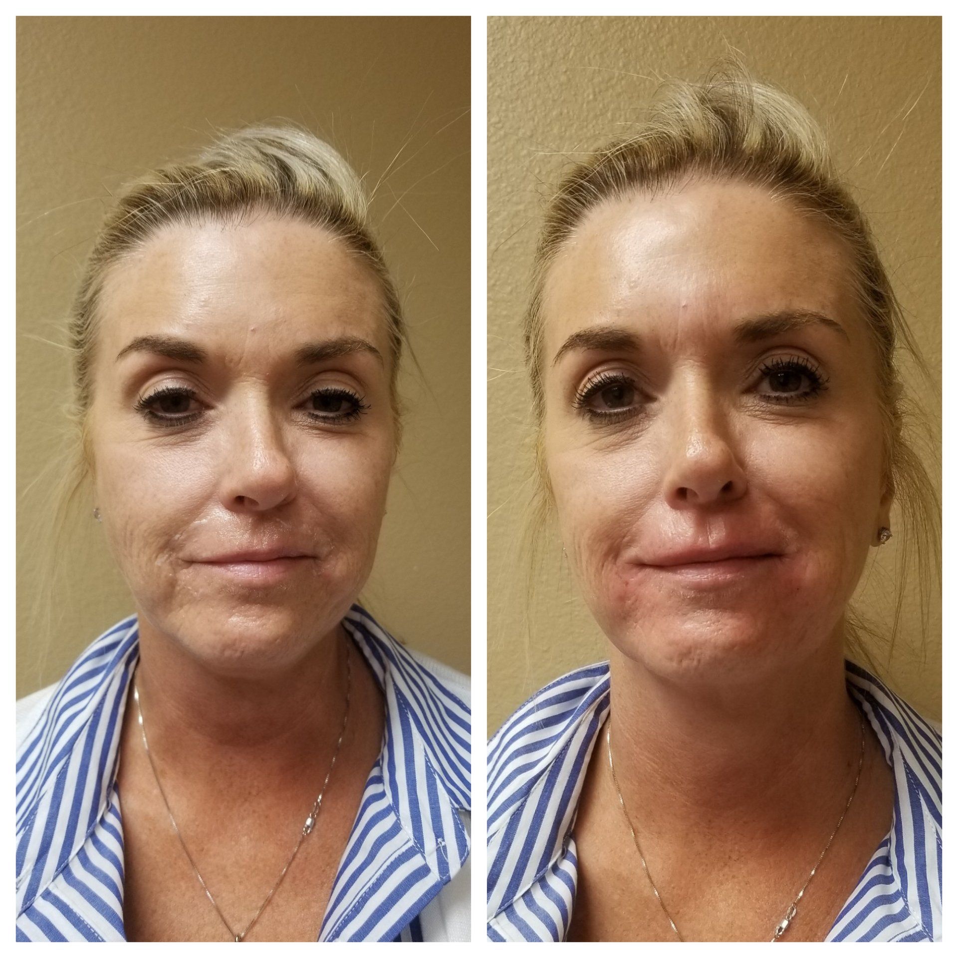 Side-by-side comparison of a woman's face before and after a cosmetic procedure. Skin appears smoother on the right.