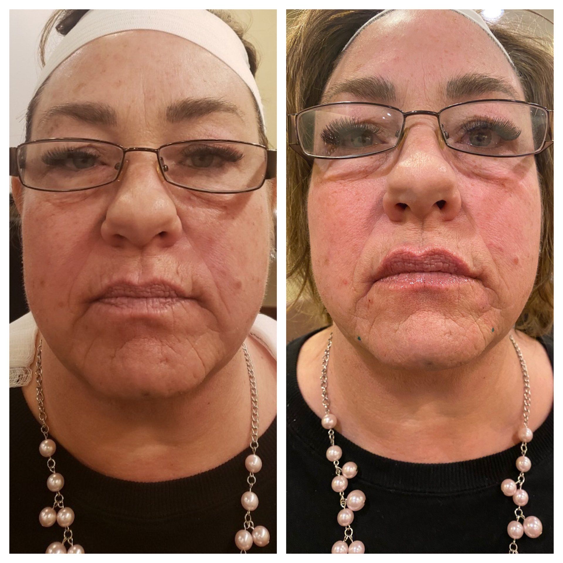 Two side-by-side photos of a woman's face show before and after results. The after photo shows fuller lips and reduced wrinkles.
