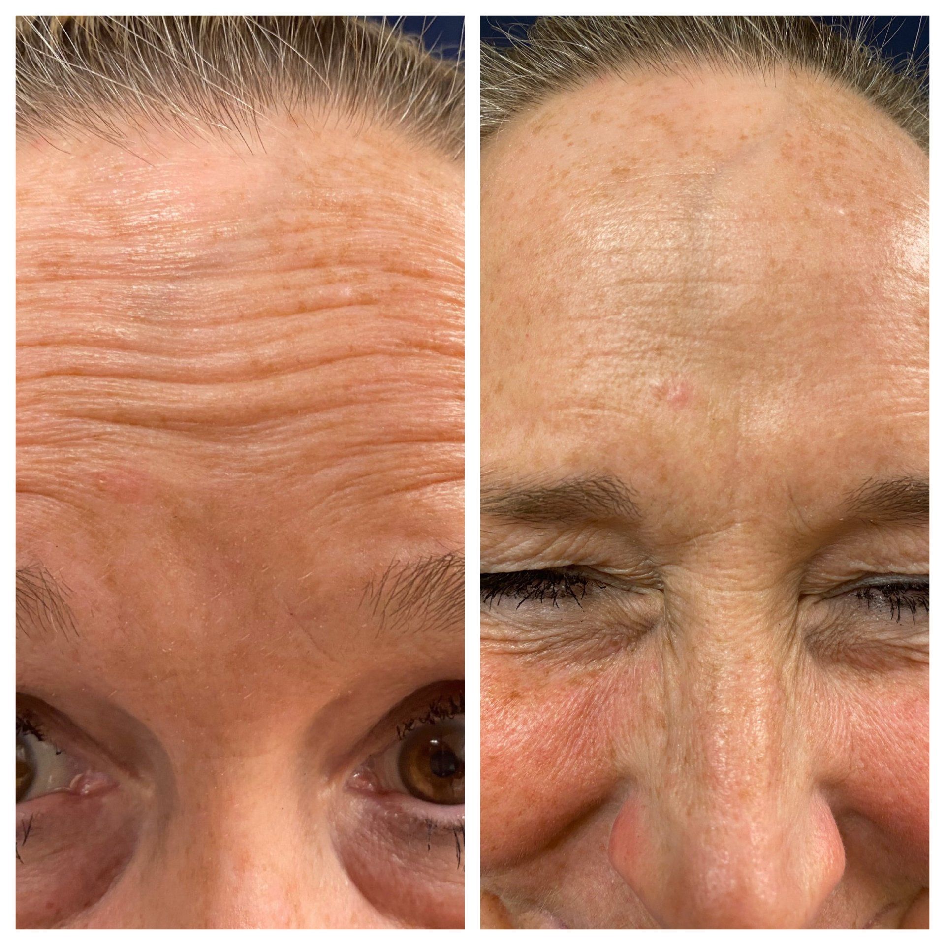 Comparison of a person's forehead before (left) and after (right) a treatment, showing a reduction in forehead wrinkles.