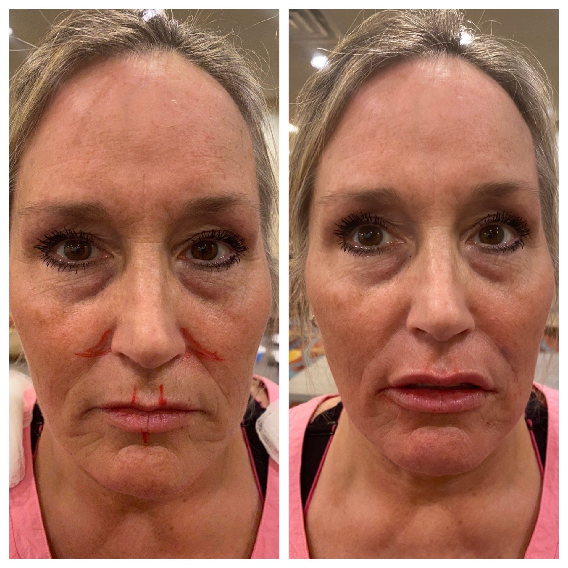 Before-and-after comparison: Woman's face with red markings indicating cosmetic procedure, then the finished result with fuller lips.