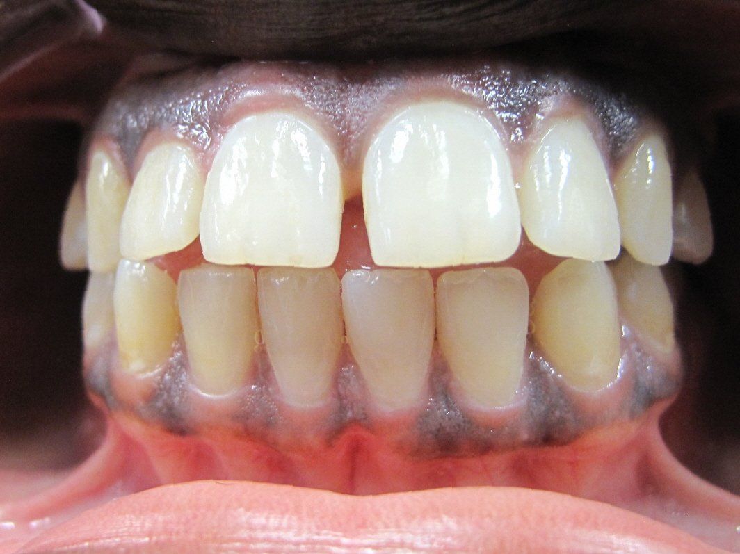 front teeth spaced out and protruding forward before orthodontic treatment