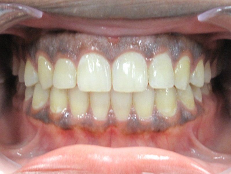 straight and even smile after orthodontic treatment