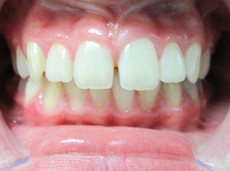 smile with front tooth gap