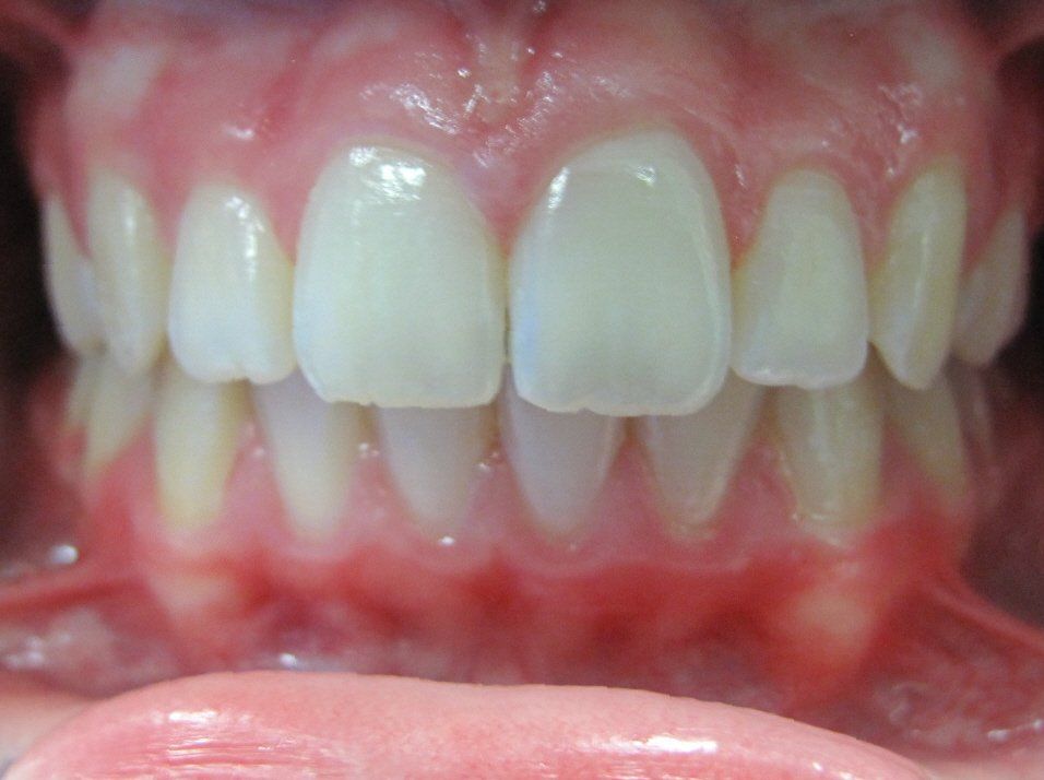 smile with front tooth gap closed