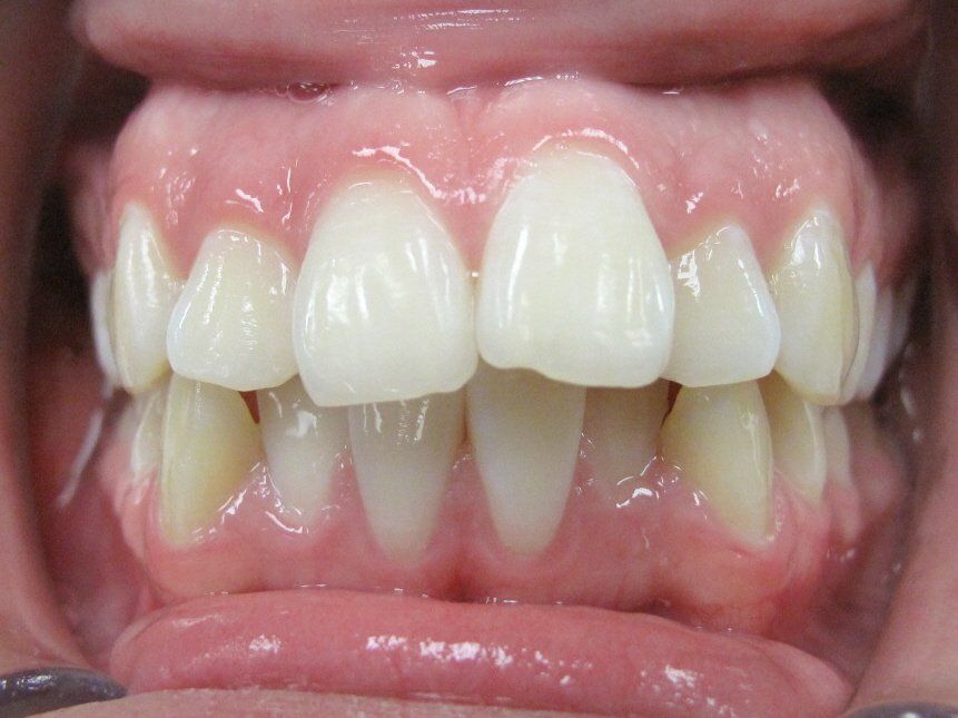 raised up and sunken back teeth before orthodontic treatment