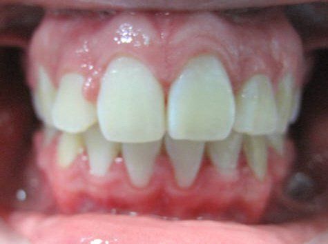 consistently placed teeth after orthodontic treatment