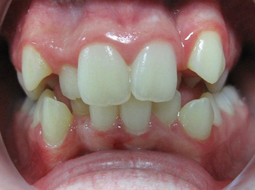 misaligned teeth