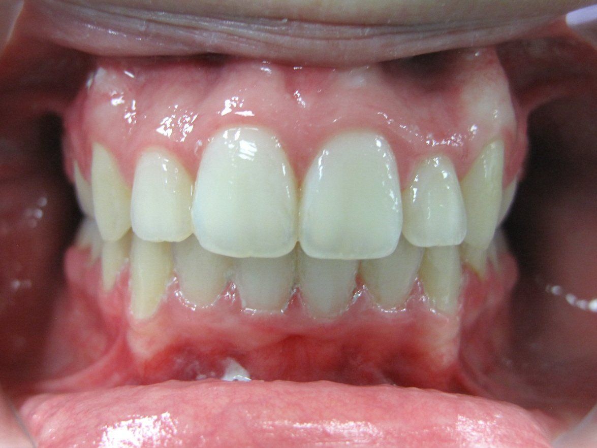 corrective alignment of teeth through orthodontics