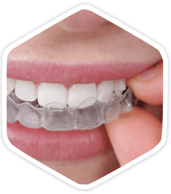 Invisible braces - Invisalign - Invisible dental pin - ExpertDent