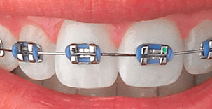 blue brackets for traditional children's braces