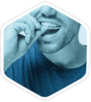inserting Invisalign® clear braces onto teeth
