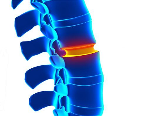 Symptoms of Spinal Stenosis