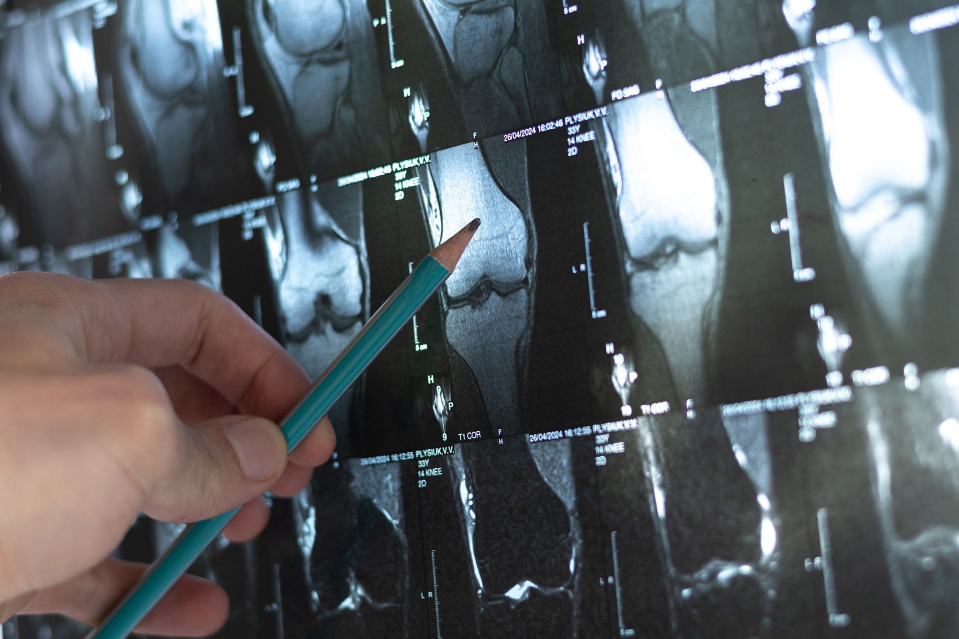 Una persona indica una radiografia di un ginocchio con una matita.