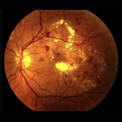 Unhealthy Retina