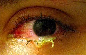 the infection or swelling of the outer membrane of the eye