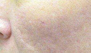 After Acne Scars — Poughkeepsie, NY — Wellness and Skincare Medical Center