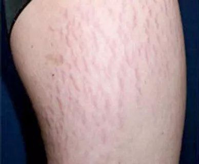 Before Stretch Marks — Poughkeepsie, NY — Wellness and Skincare Medical Center
