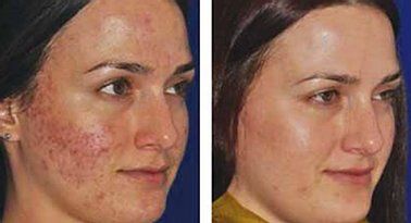 Before and After Acne — Poughkeepsie, NY — Wellness and Skincare Medical Center