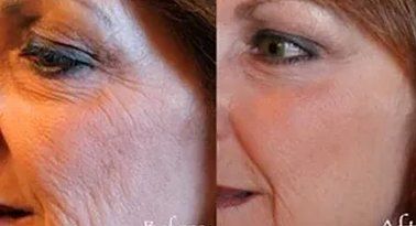 Before and After Wrinkles — Poughkeepsie, NY — Wellness and Skincare Medical Center