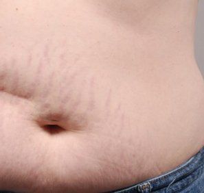 Before Belly Stretch Marks — Poughkeepsie, NY — Wellness and Skincare Medical Center