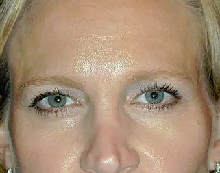 Before Brow Lift — Poughkeepsie, NY — Wellness and Skincare Medical Center