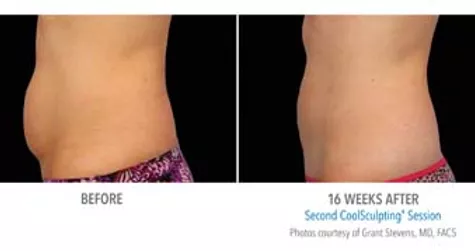 Coolsculpting Abdomen — Poughkeepsie, NY — Wellness and Skincare Medical Center