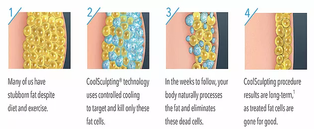 Coolsculpting Process — Poughkeepsie, NY — Wellness and Skincare Medical Center