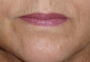 After Droopy Mouth — Poughkeepsie, NY — Wellness and Skincare Medical Center