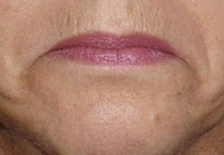 Before Droopy Mouth — Poughkeepsie, NY — Wellness and Skincare Medical Center