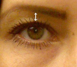 Before Eye Dermal Filler — Poughkeepsie, NY — Wellness and Skincare Medical Center